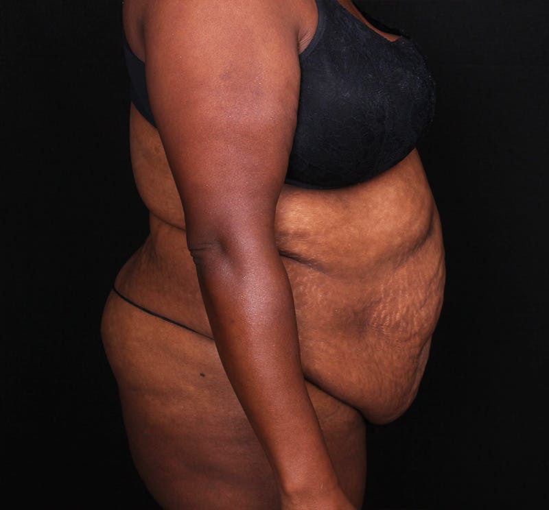 Abdominoplasty Before & After Gallery - Patient 301814 - Image 3