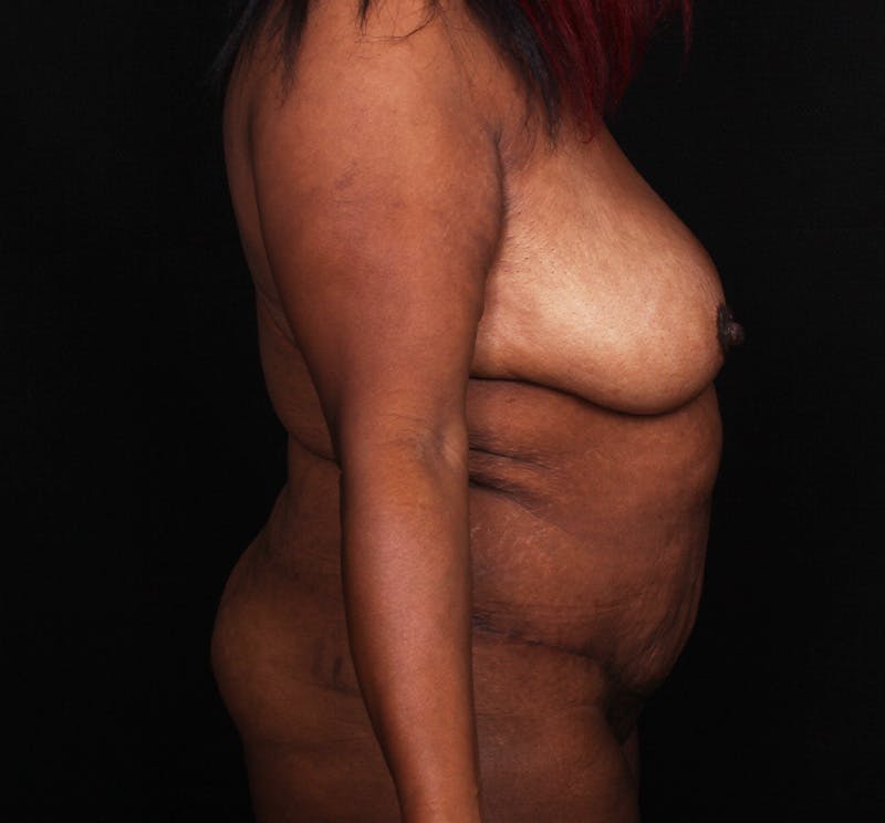 Abdominoplasty Before & After Gallery - Patient 301814 - Image 4