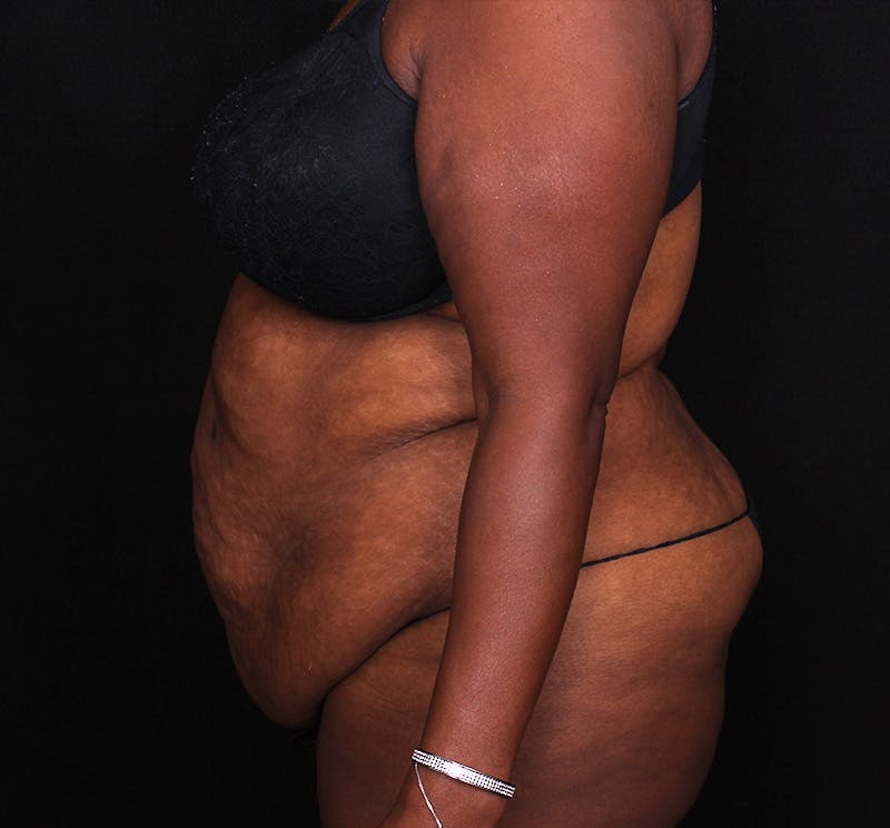 Abdominoplasty Before & After Gallery - Patient 301814 - Image 5