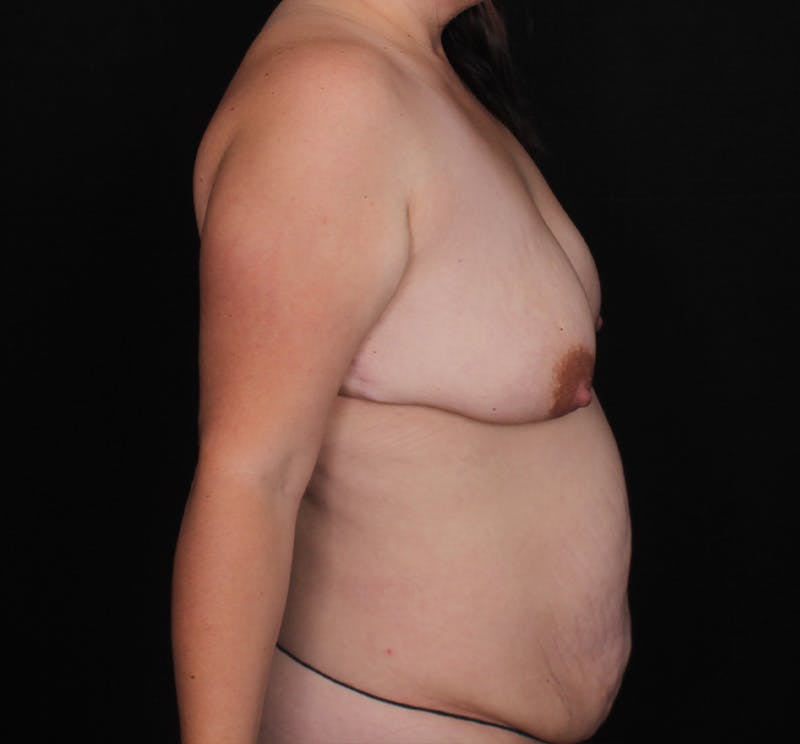 Breast Augmentation with Lift Before & After Gallery - Patient 139615 - Image 3