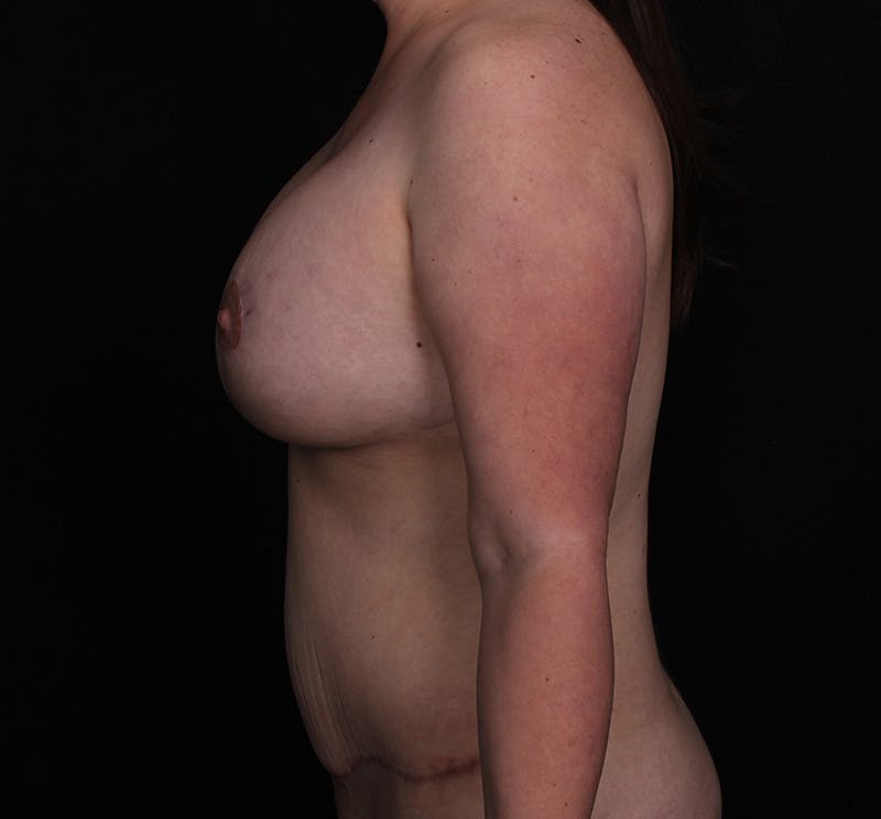 Breast Augmentation with Lift Before & After Gallery - Patient 139615 - Image 6