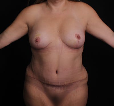 Breast Augmentation with Lift Before & After Gallery - Patient 332814 - Image 2