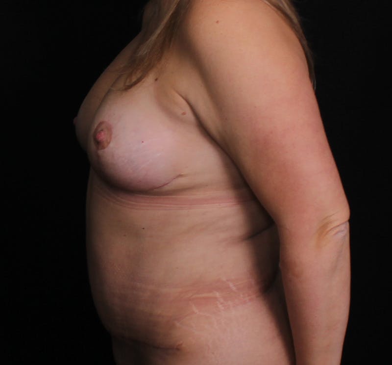 Breast Augmentation with Lift Before & After Gallery - Patient 332814 - Image 6