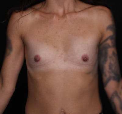 Breast Augmentation Before & After Gallery - Patient 161546 - Image 1