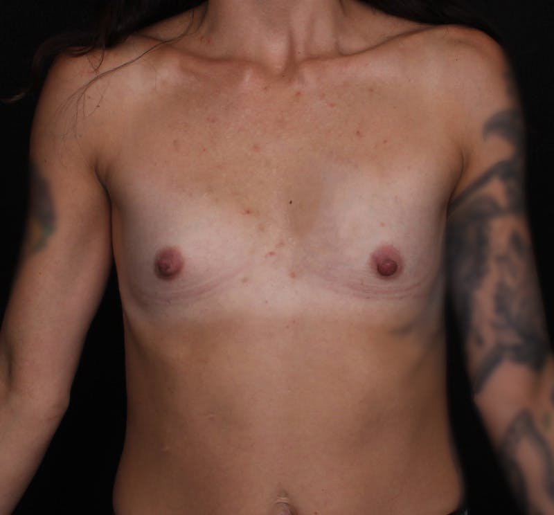 Breast Augmentation Before & After Gallery - Patient 161546 - Image 1