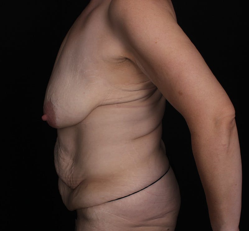 Abdominoplasty Before & After Gallery - Patient 645009 - Image 5