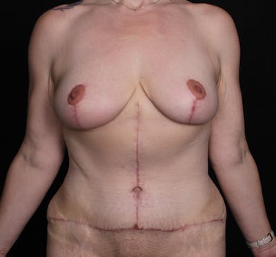 Abdominoplasty Before & After Gallery - Patient 645009 - Image 2