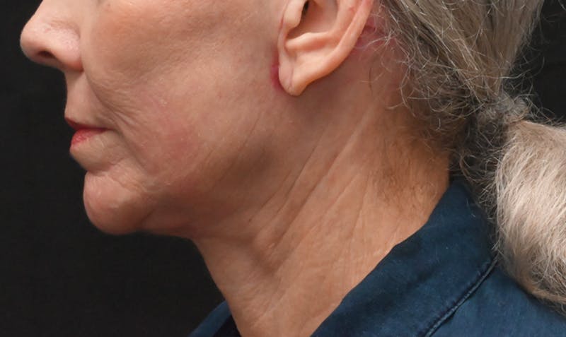 Facelift Before & After Gallery - Patient 414917 - Image 4