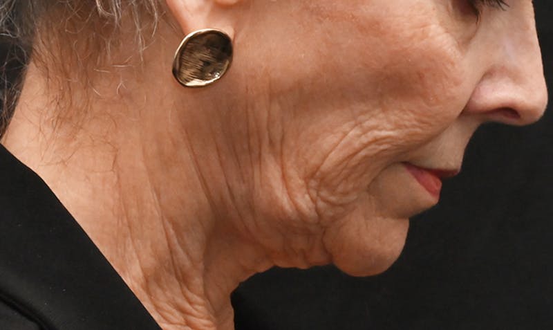 Facelift Before & After Gallery - Patient 414917 - Image 5
