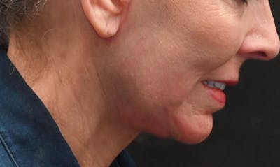 Facelift Before & After Gallery - Patient 414917 - Image 2