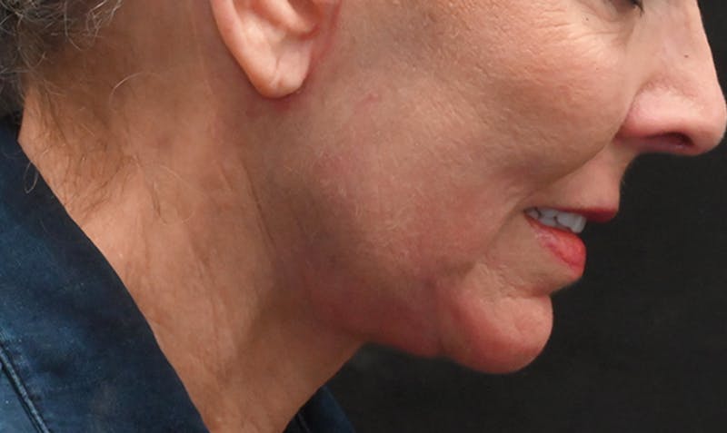 Facelift Before & After Gallery - Patient 414917 - Image 6