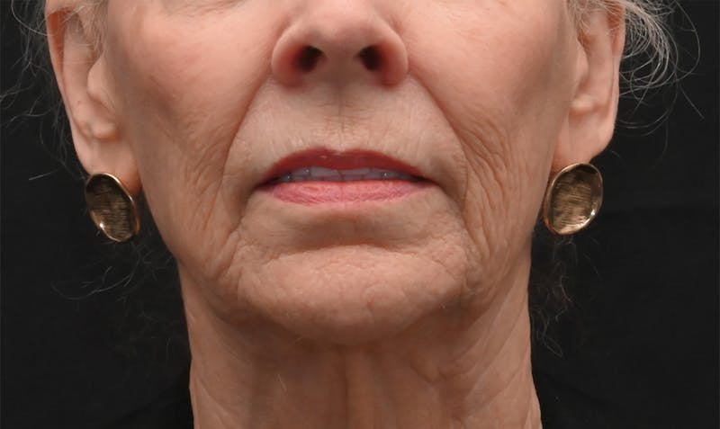 Facelift Before & After Gallery - Patient 414917 - Image 1