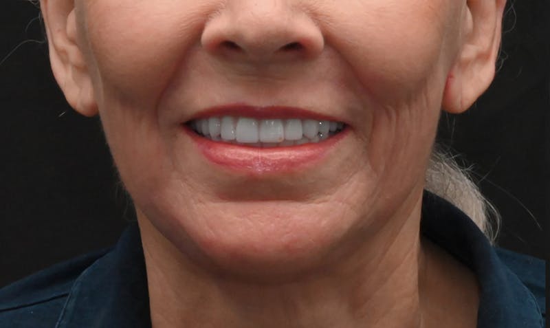 Facelift Before & After Gallery - Patient 414917 - Image 2