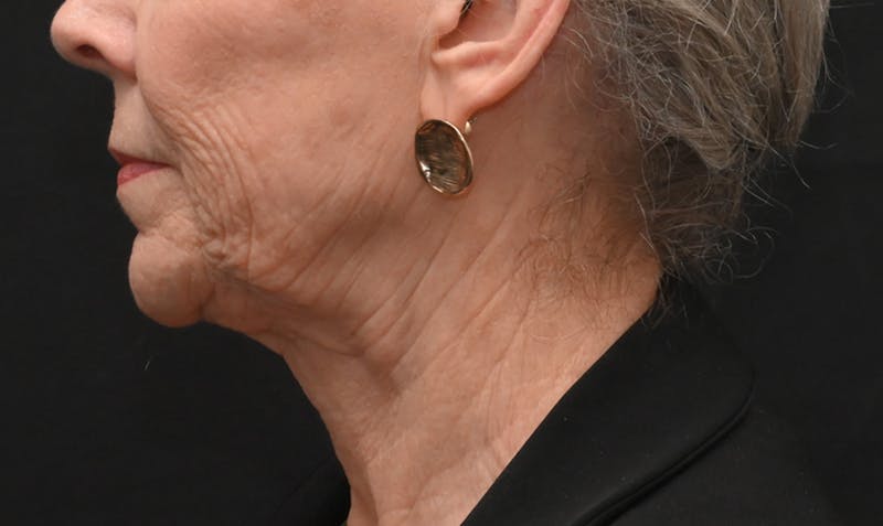 Facelift Before & After Gallery - Patient 414917 - Image 3