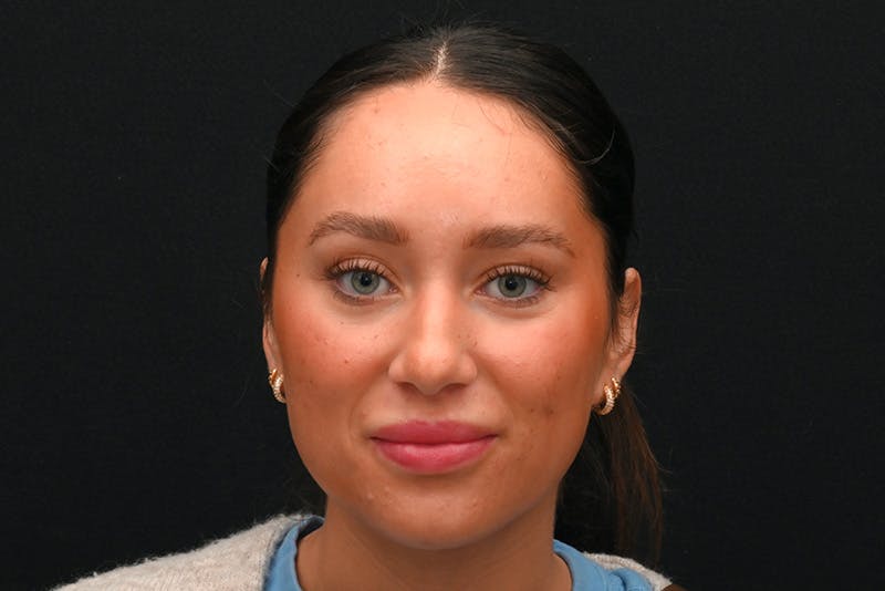 Rhinoplasty Before & After Gallery - Patient 173704 - Image 5