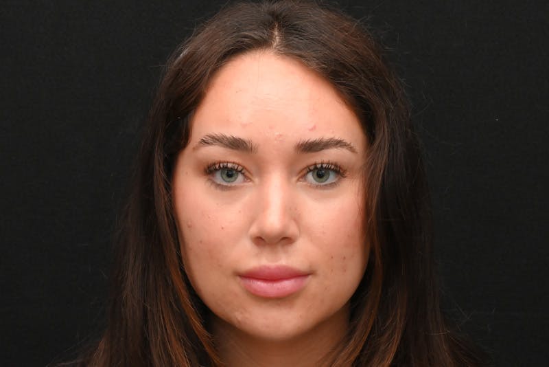 Rhinoplasty Before & After Gallery - Patient 173704 - Image 6