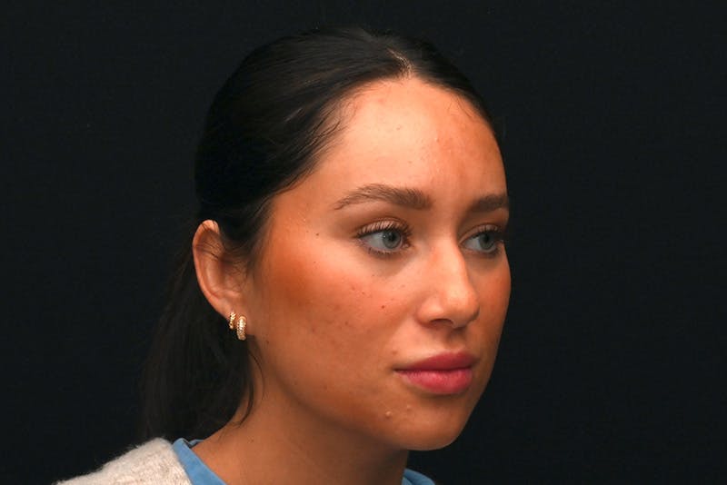 Rhinoplasty Before & After Gallery - Patient 173704 - Image 3