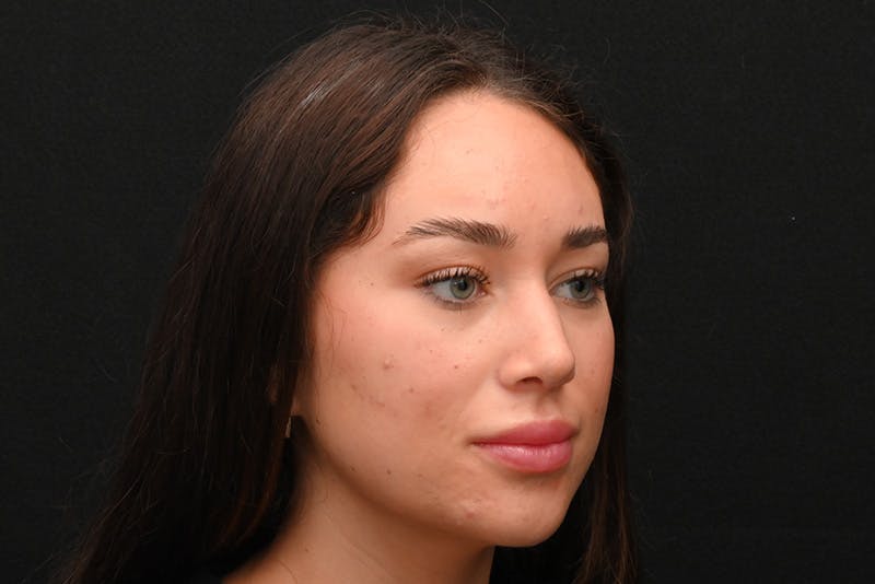 Rhinoplasty Before & After Gallery - Patient 173704 - Image 4