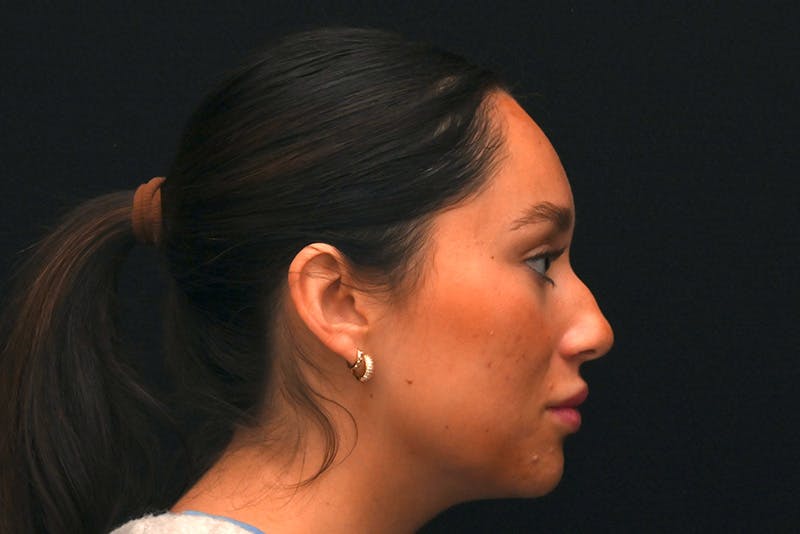 Rhinoplasty Before & After Gallery - Patient 173704 - Image 1