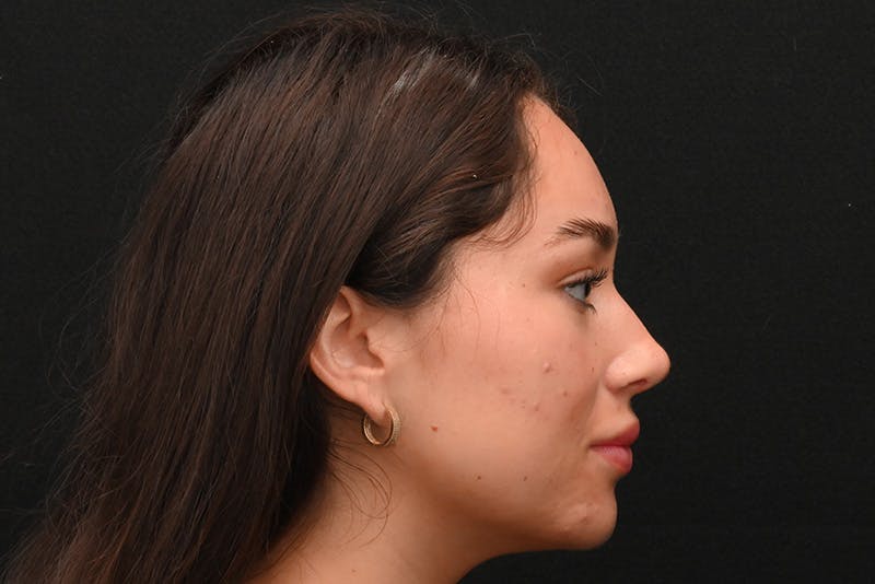 Rhinoplasty Before & After Gallery - Patient 173704 - Image 2