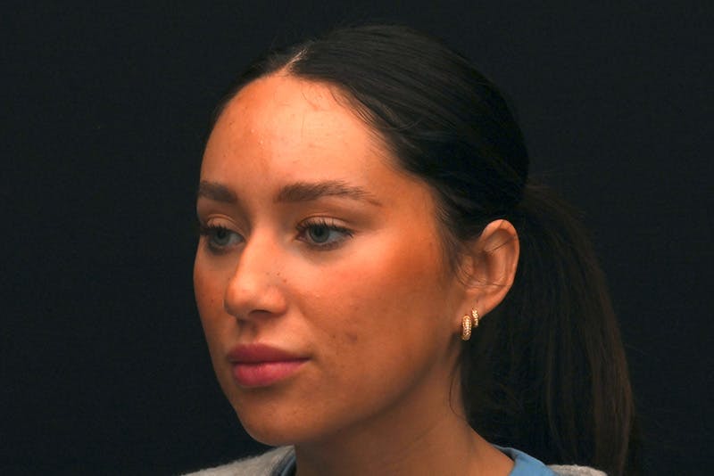 Rhinoplasty Before & After Gallery - Patient 173704 - Image 9
