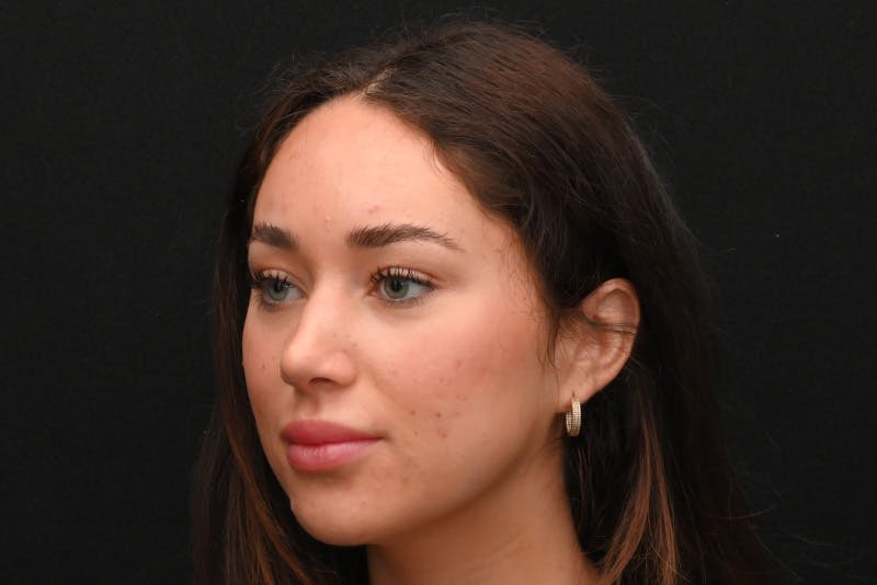 Rhinoplasty Before & After Gallery - Patient 173704 - Image 10