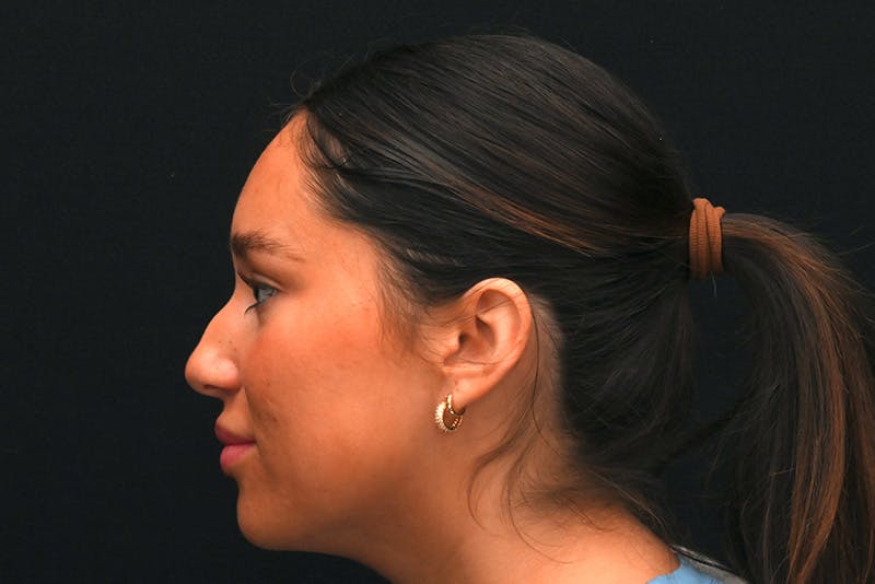 Rhinoplasty Before & After Gallery - Patient 173704 - Image 11