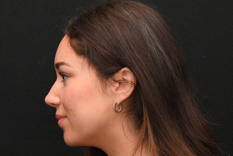 Rhinoplasty Before & After Gallery - Patient 173704 - Image 12