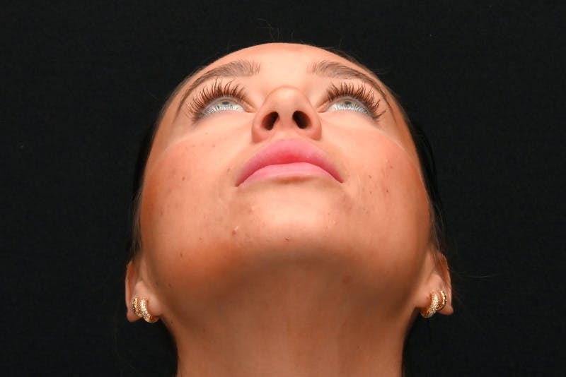 Rhinoplasty Before & After Gallery - Patient 173704 - Image 7