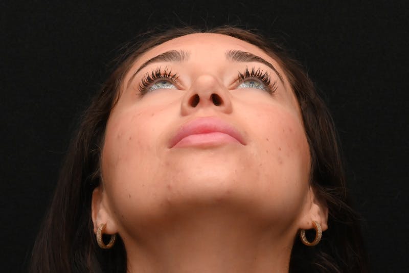 Rhinoplasty Before & After Gallery - Patient 173704 - Image 8
