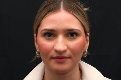 Rhinoplasty Before & After Gallery - Patient 257776 - Image 1
