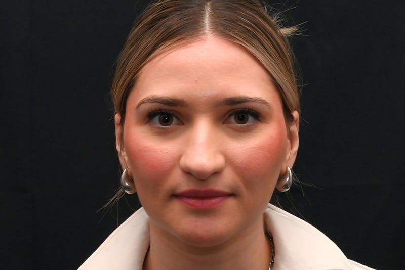 Rhinoplasty Before & After Gallery - Patient 257776 - Image 1