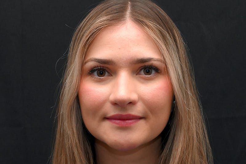 Rhinoplasty Before & After Gallery - Patient 257776 - Image 4