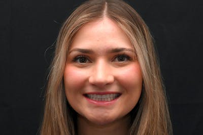Rhinoplasty Before & After Gallery - Patient 257776 - Image 2