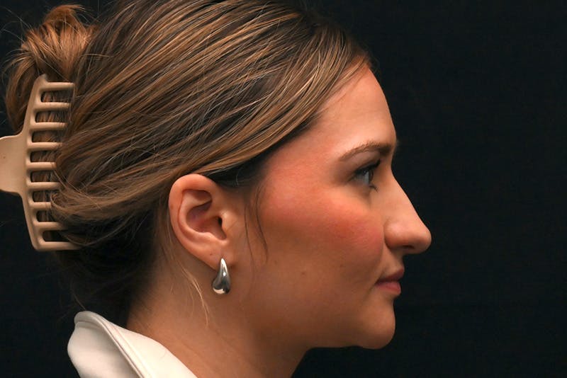 Rhinoplasty Before & After Gallery - Patient 257776 - Image 7