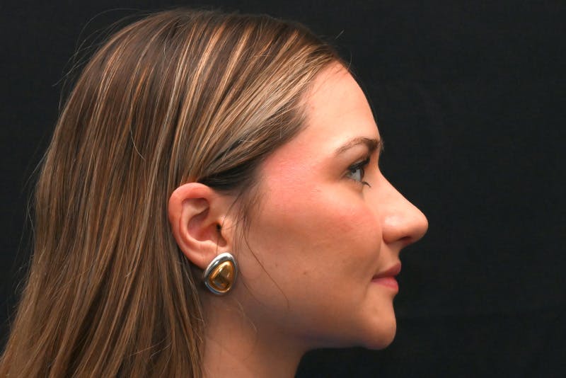 Rhinoplasty Before & After Gallery - Patient 257776 - Image 8