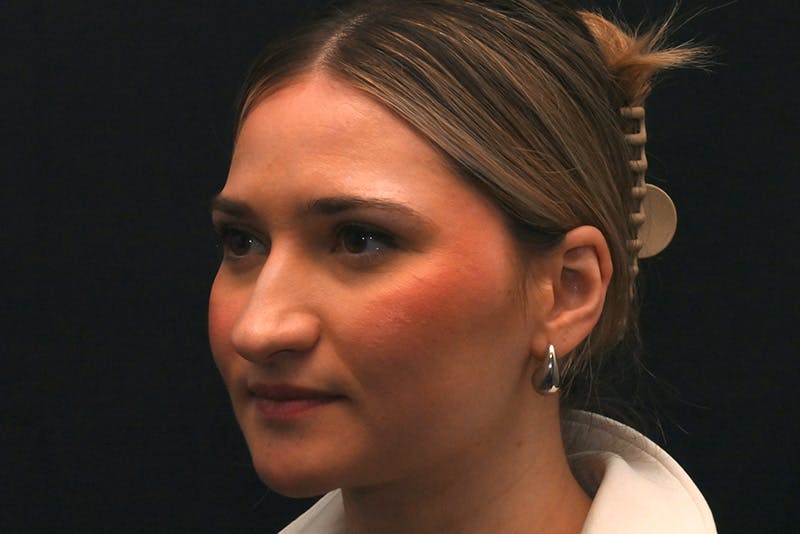 Rhinoplasty Before & After Gallery - Patient 257776 - Image 13