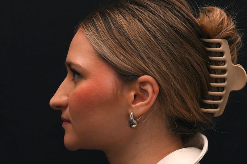 Rhinoplasty Before & After Gallery - Patient 257776 - Image 15