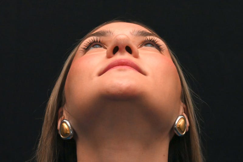 Rhinoplasty Before & After Gallery - Patient 257776 - Image 11