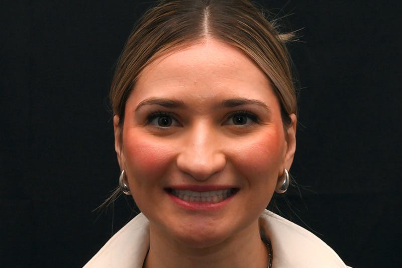 Rhinoplasty Before & After Gallery - Patient 257776 - Image 3
