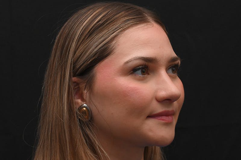 Rhinoplasty Before & After Gallery - Patient 257776 - Image 5