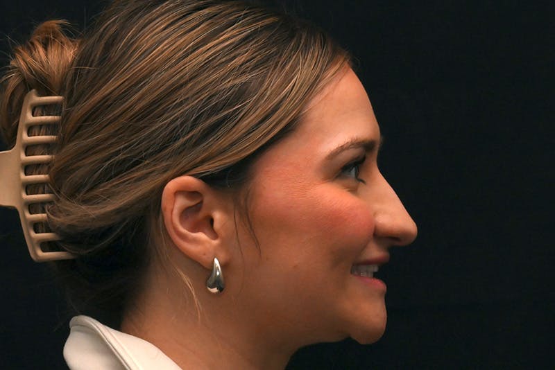Rhinoplasty Before & After Gallery - Patient 257776 - Image 9