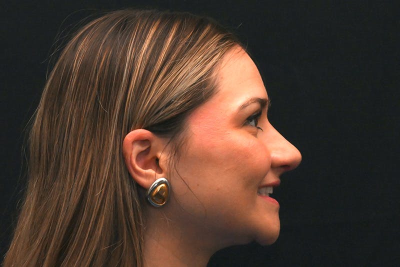 Rhinoplasty Before & After Gallery - Patient 257776 - Image 10