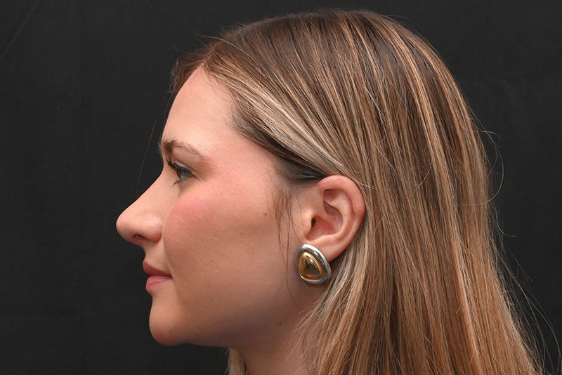 Rhinoplasty Before & After Gallery - Patient 257776 - Image 16