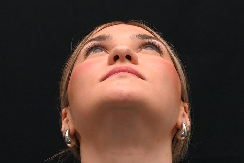 Rhinoplasty Before & After Gallery - Patient 257776 - Image 12