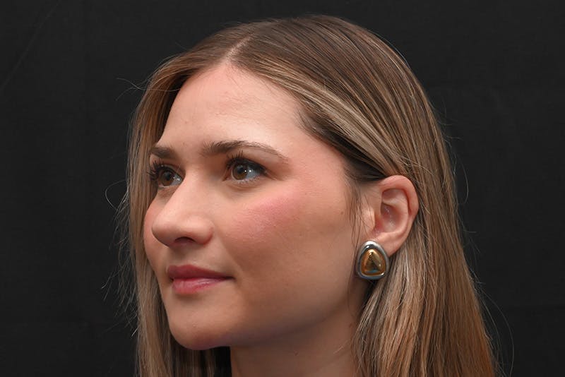 Rhinoplasty Before & After Gallery - Patient 257776 - Image 14