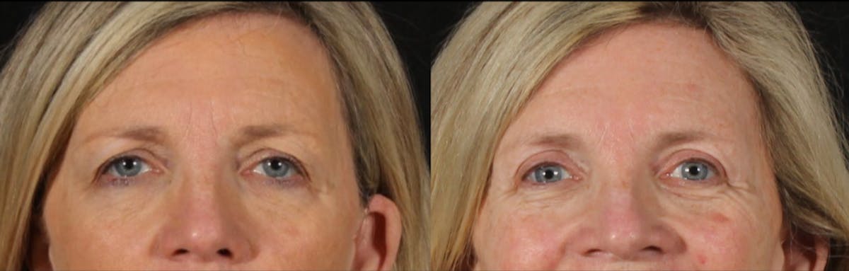 Blepharoplasty & Browlift Before & After Gallery - Patient 119406 - Image 1