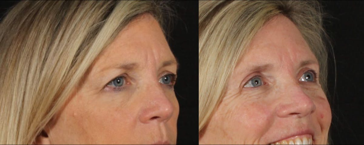 Blepharoplasty & Browlift Before & After Gallery - Patient 119406 - Image 2