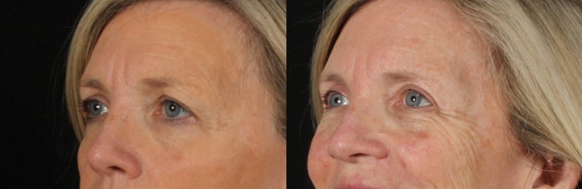Blepharoplasty & Browlift Before & After Gallery - Patient 119406 - Image 3