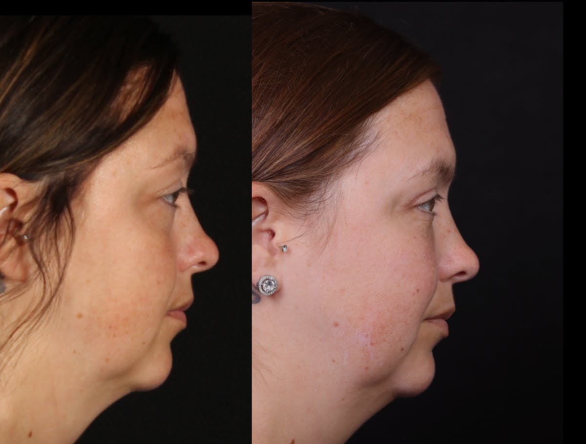 Blepharoplasty & Browlift Before & After Gallery - Patient 106388 - Image 4